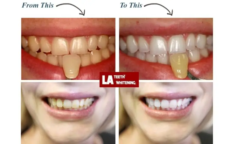 Is Laser Whitening More Expensive Than Standard Whitening—And Is It Worth It Marlow