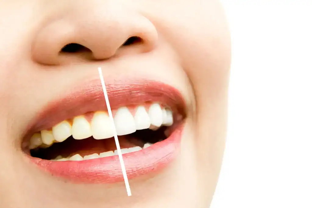 What’s the Difference Between Standard and Laser Teeth Whitening Marlow